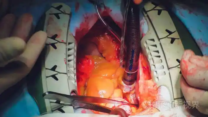 心脏手术的过程.心脏手术