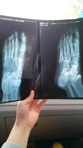 医生求解答.这是我脚崴了,受伤七天后照的,严重不?