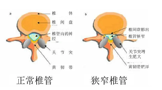 腰椎管狭窄症科普_腰椎管狭窄_症状表现_检查_治疗方式 - 好大夫在线