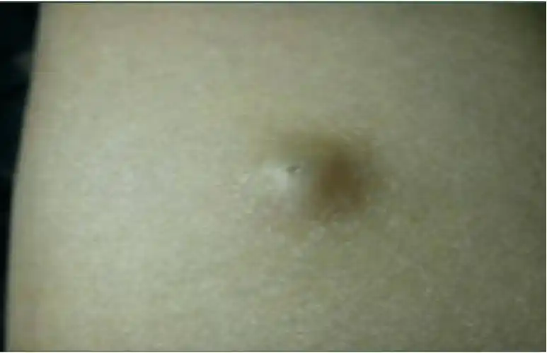 狐大医良性or恶性教您如何分辨常见体表肿物