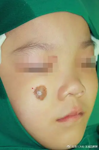 在长有巨大(长度超过20cm或者大概有8英尺)的黑色素痣的儿童身上,这样