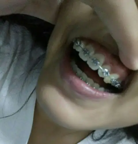 右侧3号牙的牙龈上有硬硬的突出,长条状的,不疼不痒,像骨头又像牙根