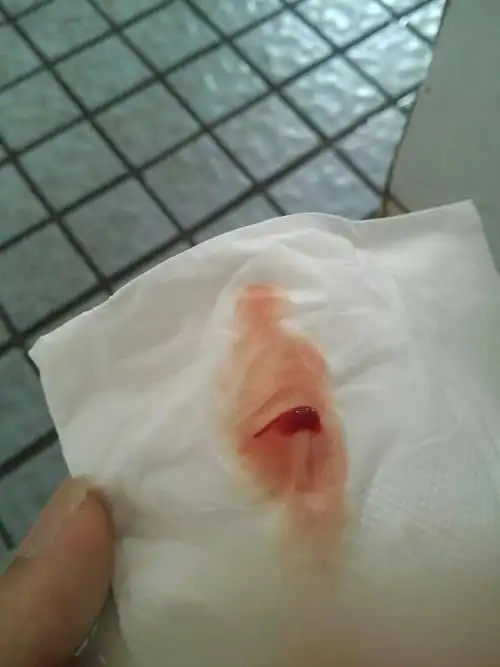 女性20岁 血尿 尿频尿痛 火辣辣的痛 感觉肚子里有好多水尿不完 怎么