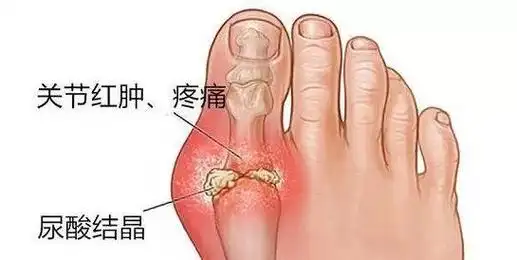 痛风 脚趾关节