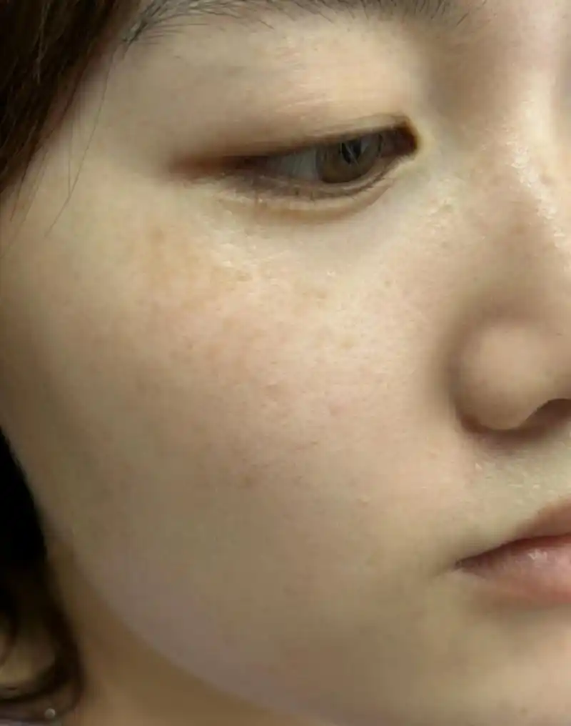 然而,不必担心,我们可以采取一些有效的方法来去除晒斑,并重拾明亮