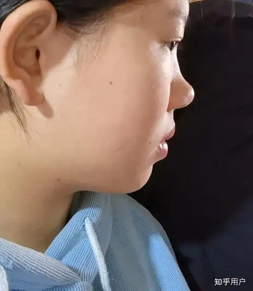 没有鼻梁鼻子塌的人是什么体验