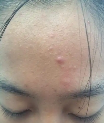 最近额头上长了很多小疙瘩,看起来不像粉刺,也不疼不痒.