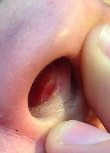 鼻子里面凹进去一块,一动就疼,怎么治,最好告诉我涂抹什么东西,很多人