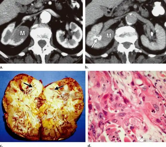肾盂肾盏尿路上皮癌丨不常见影像表现