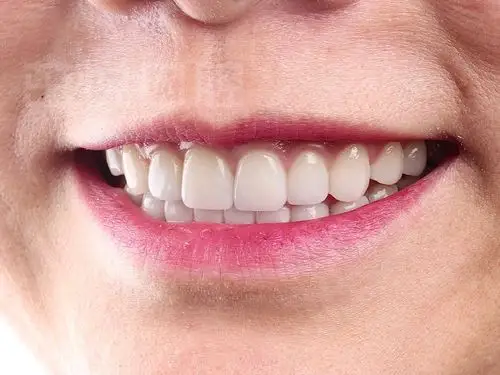 魏女士因为牙齿不整齐,在2016年就开始了矫正,现_圈子-新氧美容整形