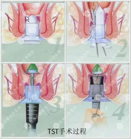 医博tst手术引领痔疮创口微小手术新潮流