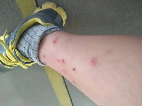 我这个是螨虫引起的嘛?