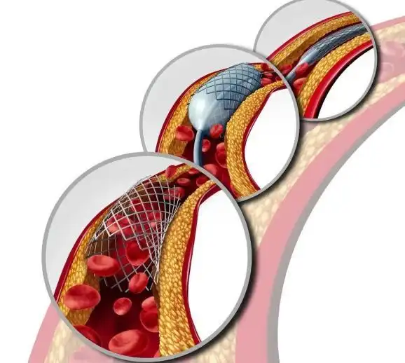 做完支架6个月,血管又堵了,是支架造成的结果?