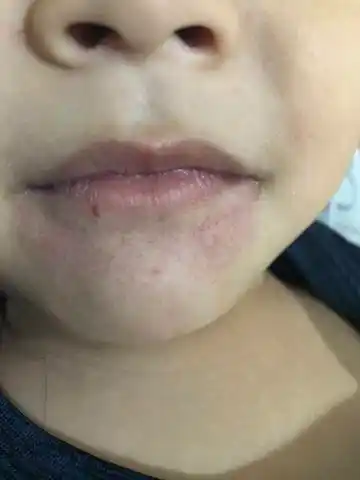 宝宝下嘴唇有皮下出血点,请问是怎麼回事,有一点点肿,有哭过.