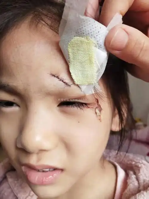 蚌埠市教育局小孩在幼儿园受伤害面部缝10针监控被删不愿负责谁来管