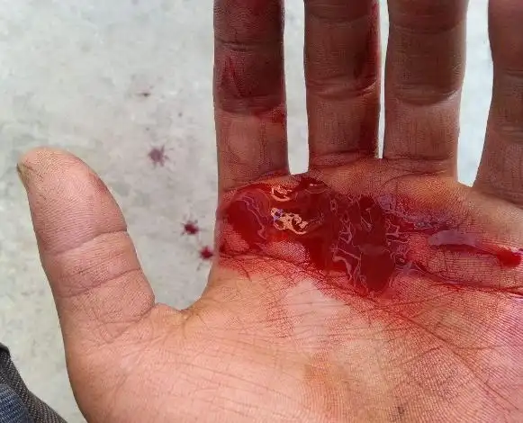 手出血的图片61