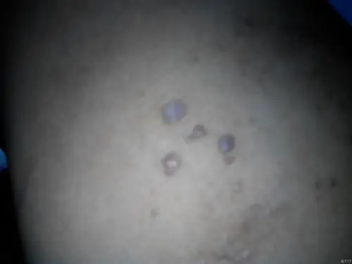 左侧臀部出现疣状突起,原来只有两三个,现在有增多的