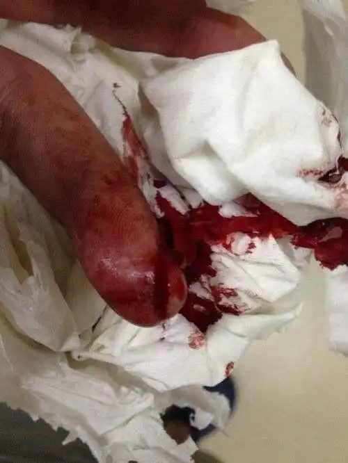 手被刀割了流血图片 - 搜狗图片搜索