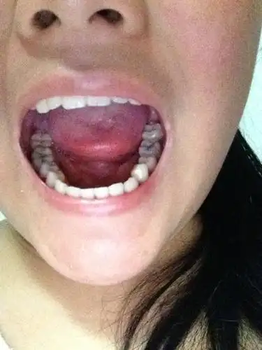 这样的牙齿正常吗?