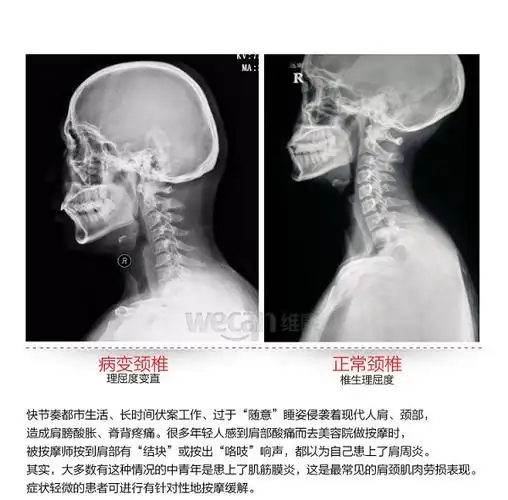 转起!颈椎病患者太极拳康复训练方法