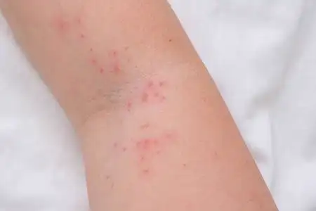 女性手臂上的皮疹,过敏反应引起的瘙痒丘疹,反应,过敏概念和皮肤病学