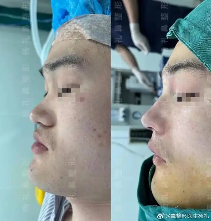 鼻综合术后5个月反馈术前术后  术前山根低塌陷,伴有鼻头肥大,鼻梁偏