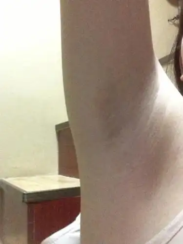 右边腋下用手捏会有一个小硬块,举起手时候是凸起的而且有疼痛感,平时