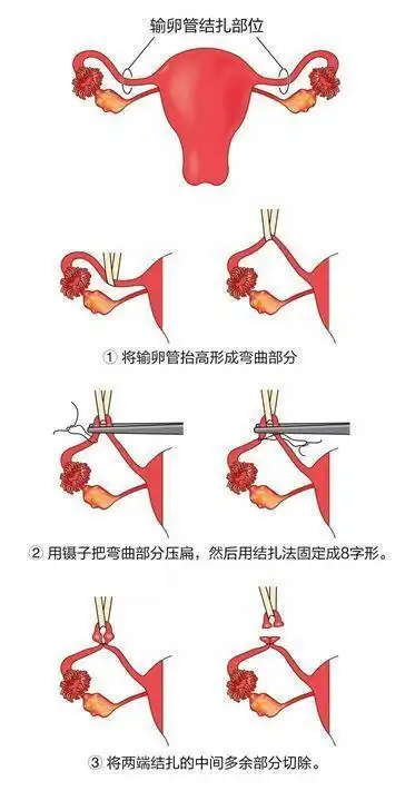 为什么中国大多是女性"结扎"?而外国是男性?中国男人该看一看