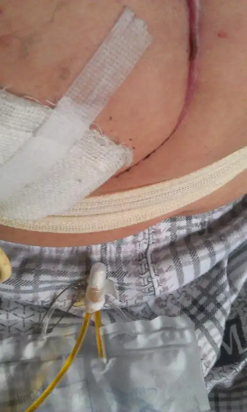 问:胆囊炎手术后,已夹t管2o天,什么时候可痊愈?