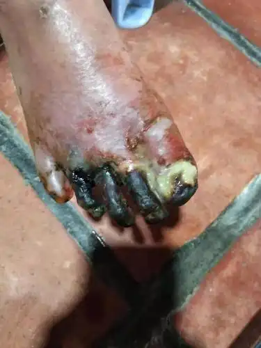 老人的脚烂成这样子,今年的三月份就开始到现在一直都在用药,但是没