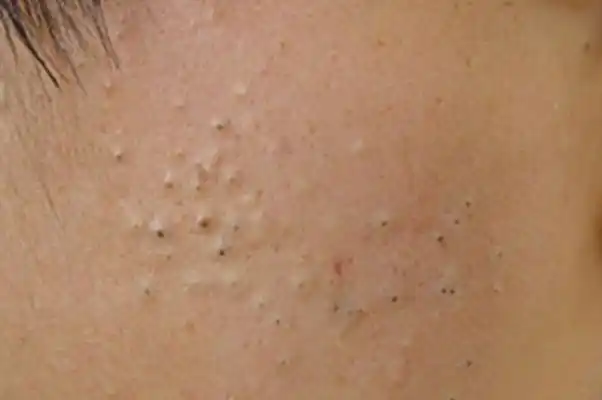 粉刺的正确处理方法粉刺的白色东西是什么