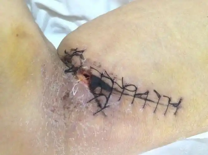 这样的伤口怎么处理?