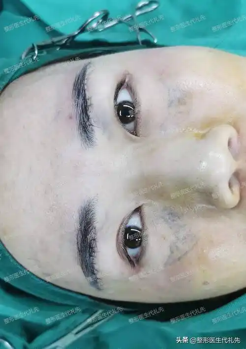 39岁女士做了眼周凹陷填充 筋膜悬吊提眉手术,术后一周拆线对比_脂肪