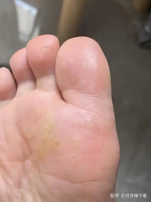 跖疣记录 - 知乎