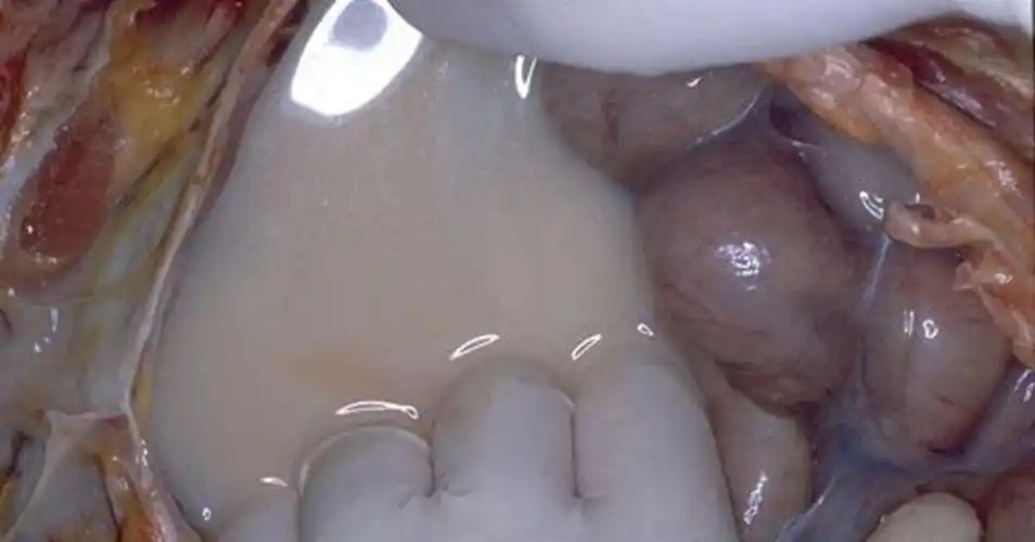 腹水介绍_腹水病因_腹水治疗_腹水医院医生_有来医生