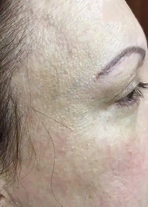 研究快讯前额纤维化脱发的毛发外损害