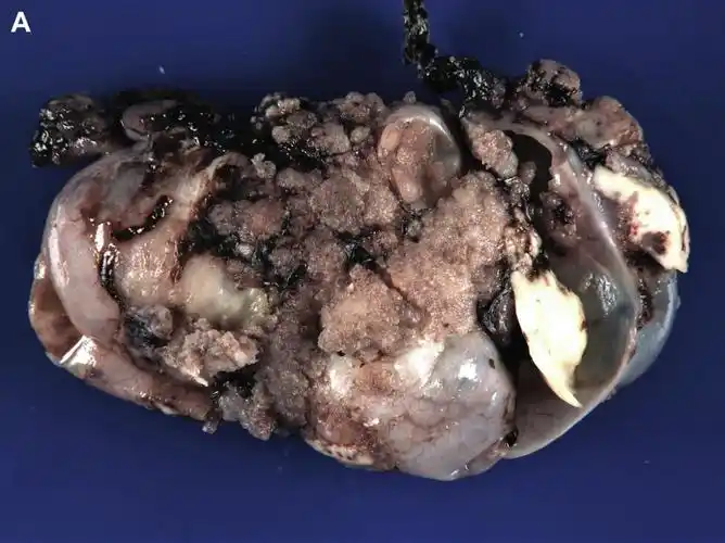 女性生殖道低级别浆液性肿瘤(一)