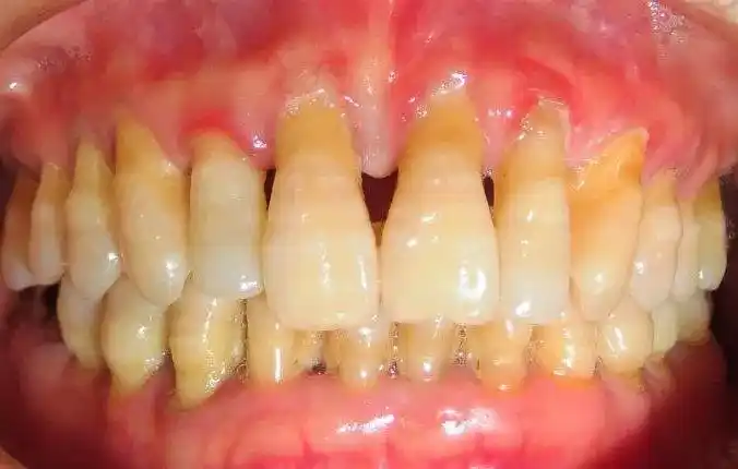 牙齿松动脱落,掉牙