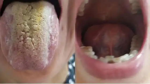 从舌头看肿瘤,胃癌,肺癌患者的共同特点,你知道多少?