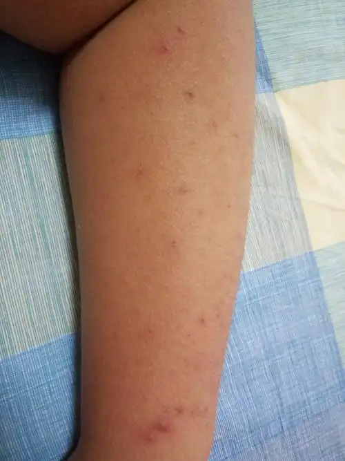 我手臂上是怎么回事,有点像粉刺,有些红.这是什么病?怎么治?谢谢