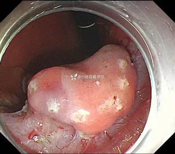胃角早癌一例,发现一例早癌,挽救一条生命,幸福一个家庭.