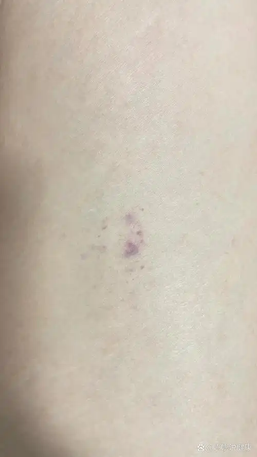 大腿内侧突然有一小片这样的紫色小黑点,有没有人知道怎么回事呀