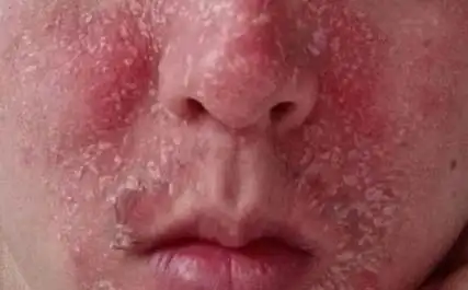 重症红皮型银屑病有什么明显表现症状啊