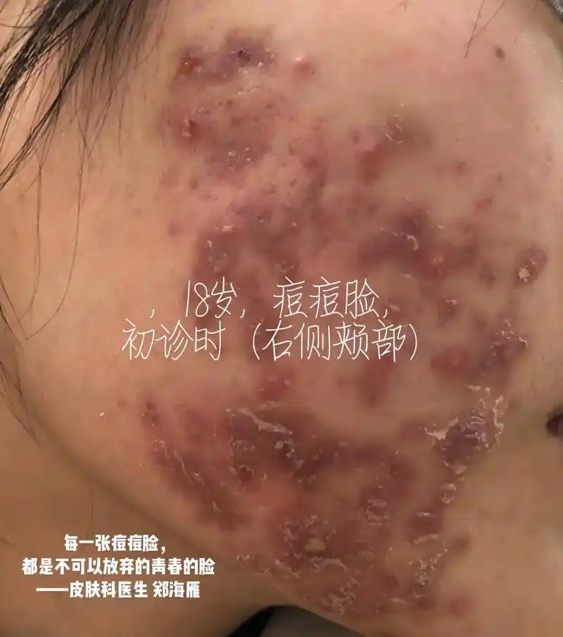 美好青春不要痘,有信心.一定会越来越美越好.#青春痘 #敏 - 抖音