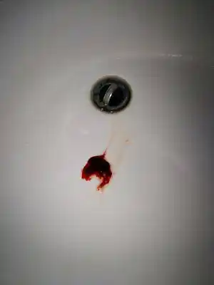 父亲已诊断是肺癌并转移,今天上午开始咳嗽并带有血,现在这个情况应该