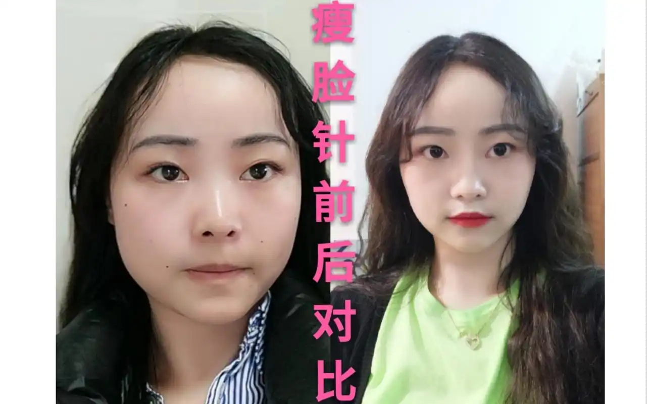 瘦脸针一个月效果对比痛不痛需要注意的事项