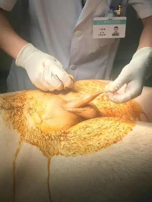 实图一一包皮环切 1