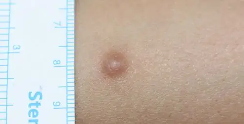 哪些皮肤肿物需要手术切除?