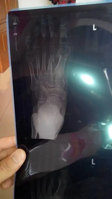 我左脚脚背第四趾骨骨折错位有十来天才发现骨折错位了不做手术能对