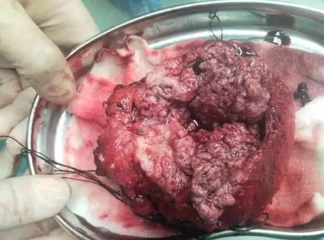 膀胱癌的临床表现